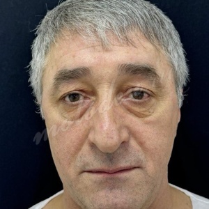 Лобно-височный + блефаропластика_Делецкий