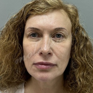 Лобно-височный + блефаро_Делецкий