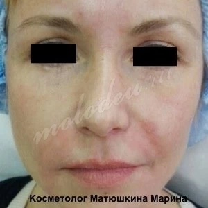 Носослезные борозды Матюшкина М.