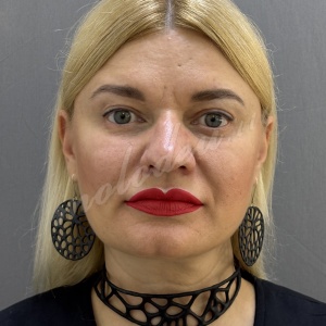 Блефаро_Делецкий