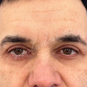 Круговая блефаро_Гасымов