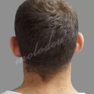 Коорекция ушей_Агаев