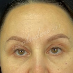 Гусев_лобно-височн_блефаро