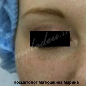Носослезные борозды Матюшкина