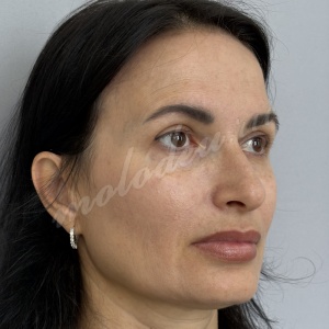 Блефаро_Мирзарахимов