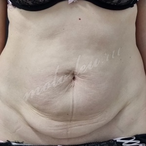 Абдомино_Колбасин