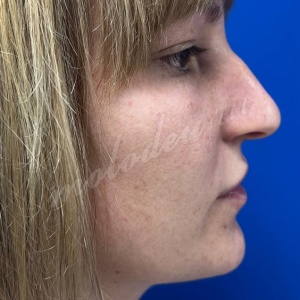 Риносепто_Пирмагомедов