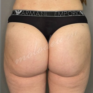 Агаев_липофилинг ягодиц