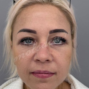 Блефаро_Каракаева