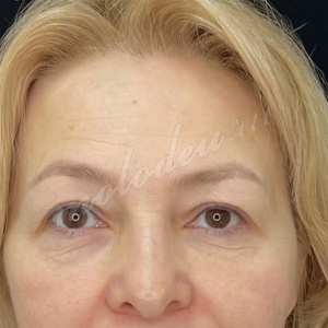 Гусев_эндоскопическая_верхней трети