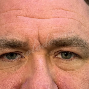 Гуляев_лобно височ_блефаро