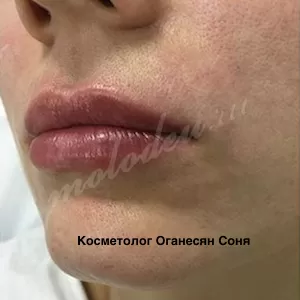 Убрать носогубные складки