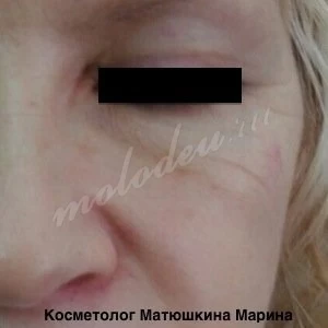 Коррекция скул Матюшкина