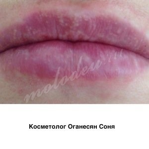 Коррекция формы губ