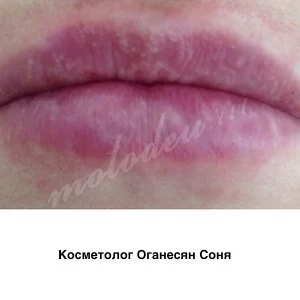 Коррекция формы губ