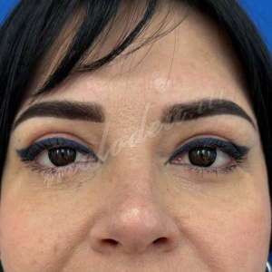 Блефаропластика_Каракаева