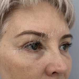 Блефаро_Каракаева