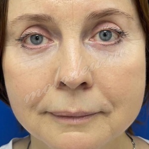 Агаев_блефаро_липофилинг носослезной