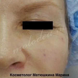 Коррекция скул Матюшкина