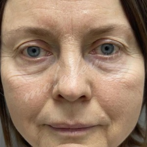 Агаев_блефаро_липофилинг носослезной