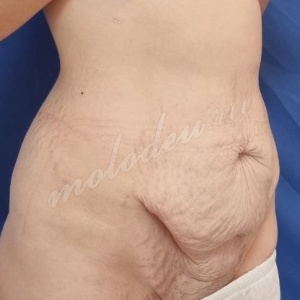 Абдомино_Колбасин