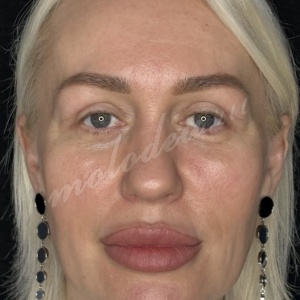 Блефаро_Овсиенко