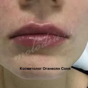 Увеличение губ — Оганесян