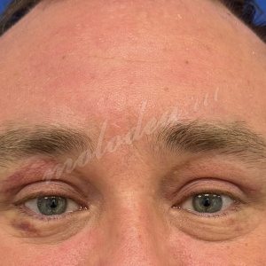 Гуляев_лобно височ_блефаро