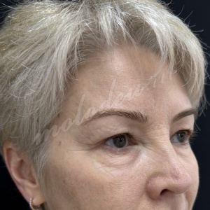 Блефаро_Каракаева