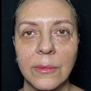 Липолиз и нитевой лифтинг_Лукина