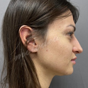 Липосакция подбородка_Мирзарахимов