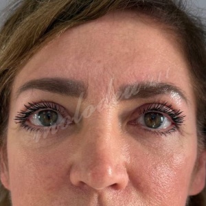 Каракаева_блефаро