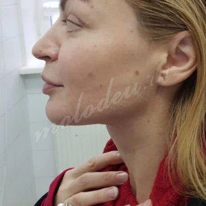 Платизмопластика Гоглов