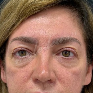 Каракаева_блефаро