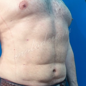 Липомоделирование Мирзарахимов