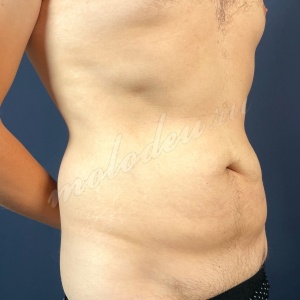 Никонов_абдомино