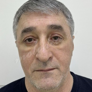 Лобно-височный + блефаропластика_Делецкий