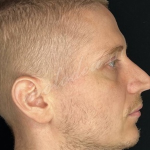 Пирмагомедов_риносепто