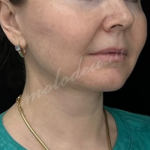 Гусев_нижняя подтяжка