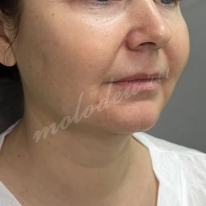 Гусев_нижняя подтяжка