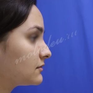 Ринопластика_Агаев