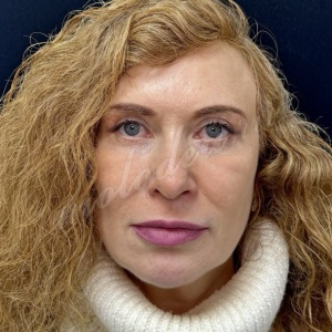 Лобно-височный + блефаро_Делецкий