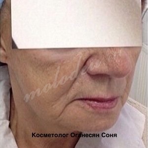 Контурная пластика лица