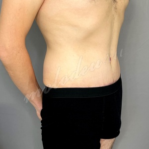 Никонов_абдомино