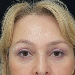 Гусев_эндоскопическая_верхней трети