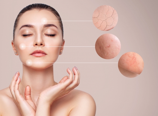 Как вылечить купероз и розацеа на лице навсегда: 4 реальные истории | Beauty Insider