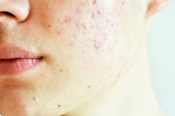Как убрать шрамы от прыщей и избавиться от рубцов на лице: эффективные средства для лечения