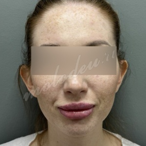 Отопластика_Делецкий