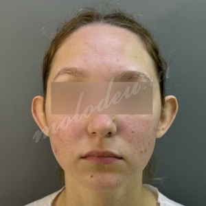 Отопластика _Делецкий