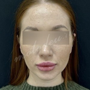 Отопластика_Делецкий